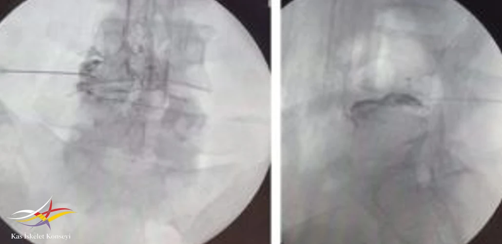 L4-5 diskografi ve transforaminal epidural enjeksiyon işlem görüntüsü.
