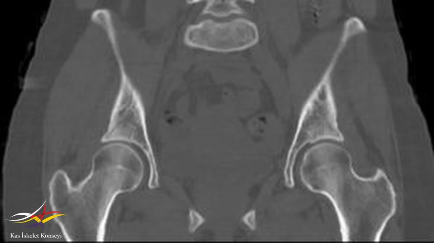 BT incelemesinde sol tokanter majörde şüpheli fraktür hattı izlenmekte.