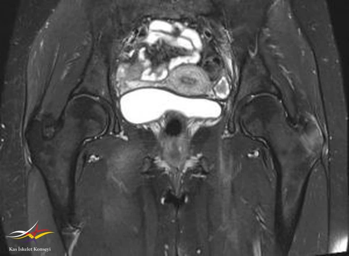 Koronal T1 ağırlıklı MRG incelemesi.