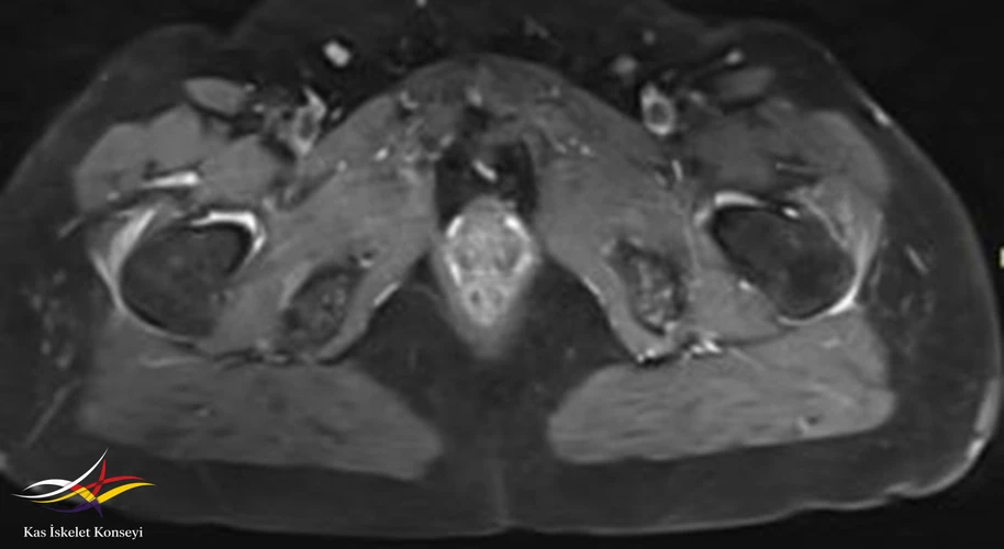 Kalça MRG, aksiyal kesit.