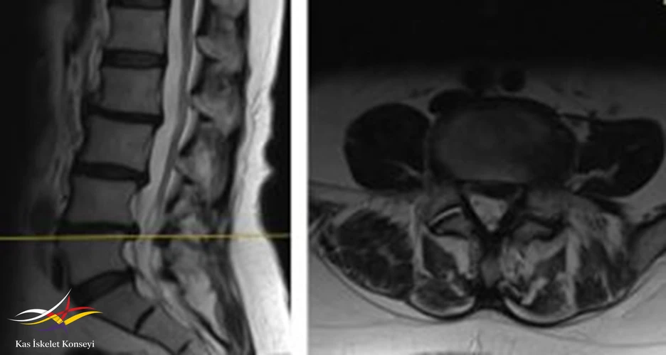Lomber MRG, L4-5 seviyesi median kesit.