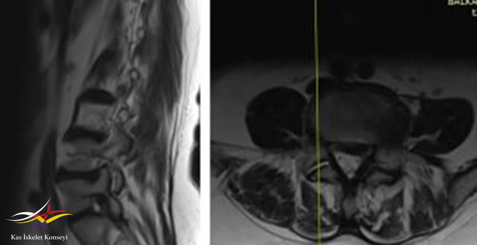 Lomber MRG, L4-5 seviyesi sağ paramedian kesit.
