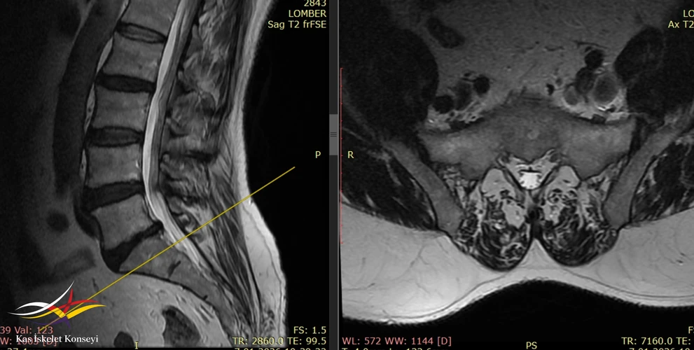 Lomber MRG, daha kaudal kesitte sol iiak arter ve ven ilişkisi görülmekte.