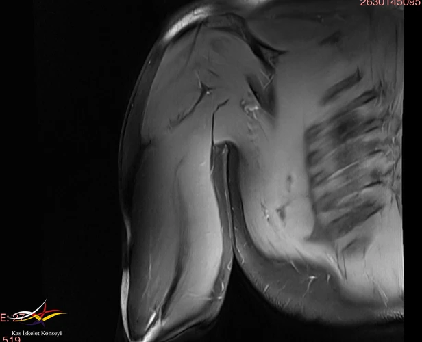 Üst kol MRG: Normal.