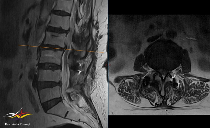 Lomber MRG: L2-3 seviyesinde rest stenoz görülmekte.