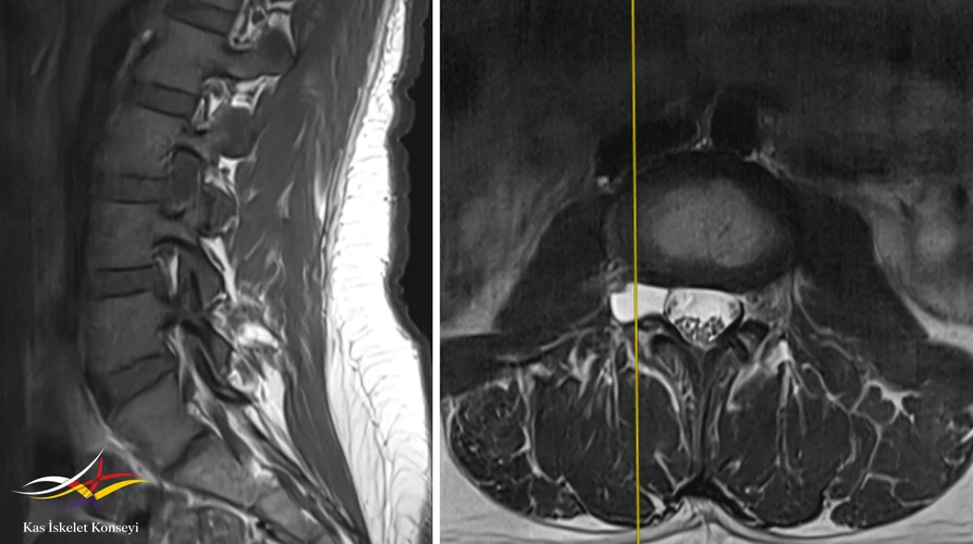 Lomber MRG. Solda T1 ağırlıklı sagittal, sağda T2 ağrılıklı aksiyal kesit: L3-4 sevitesinde sağda foramende kistik lezyon görülmekte (perinöral kist).