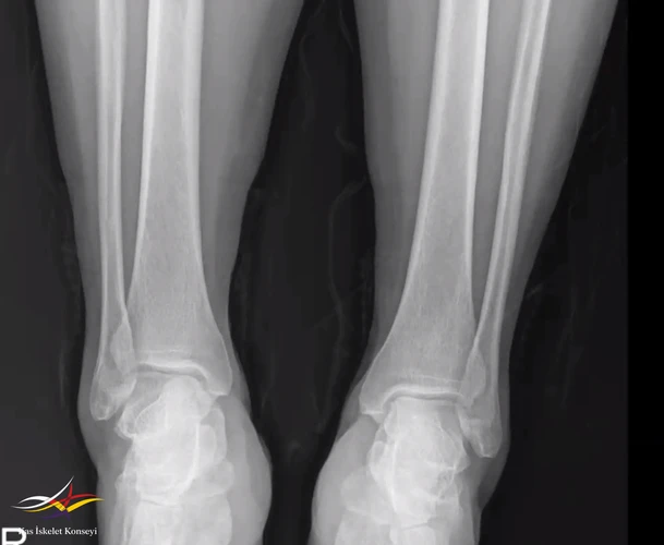 Bilateral ayak bileği grafisi.
