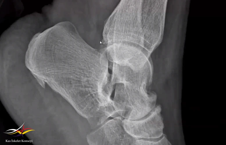 Ayak bileği lateral grafide kalcaneal Spur + Talonavicular eklem dejenrasyonu.