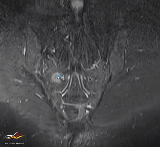 Sakroiliak MRG'de sakrum sağında intansite artışı (ekleme komşu olmayan bölgede).