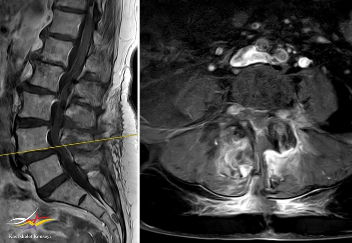 Ameliyat sonrası dönemde yapılan kontrastlı lomber MRG'de iki yanlı olarak paravertebral kaslarda kontrat tutulumu görülmekte.