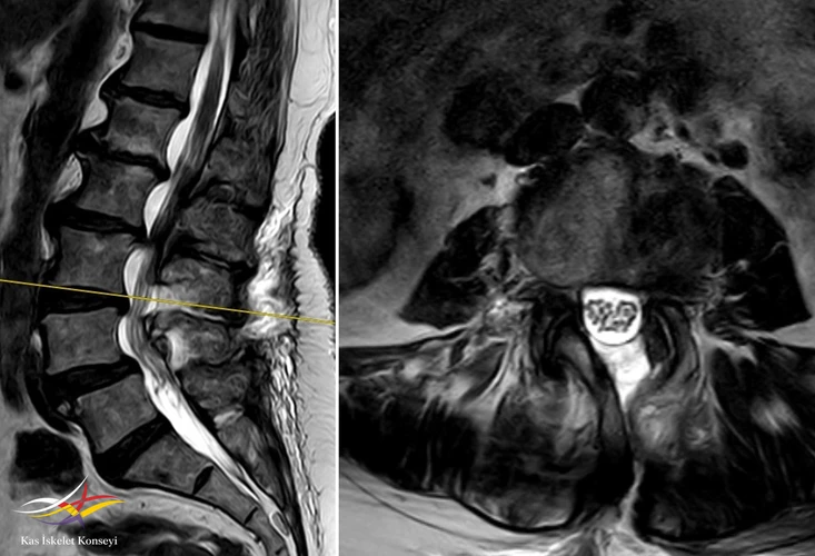 Ameliyat sonrası MRG: L3-4 seviyesindeki dekompresyon görülmekte.