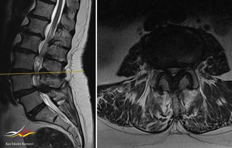 L3-4 seviyesinde belirgin bir kanal darlığı mevcut.
