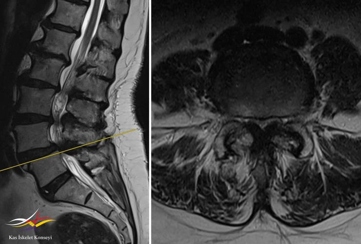 L4-5 seviyesinde dejeneratif listezis ve belirgin kanal darlığı görülmekte.