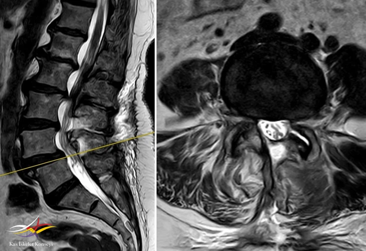 L4-5 seviyesindeki dekompresyon görülmekte.