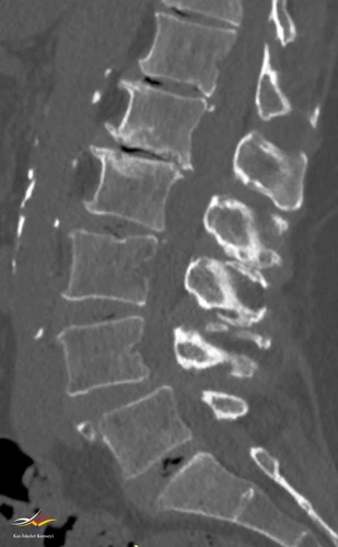 Lomber BT incelemesi.