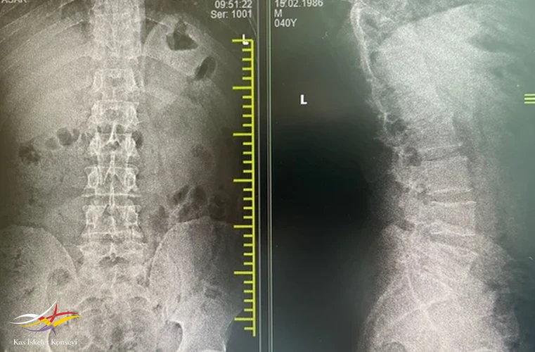 AP ve lateral LSV