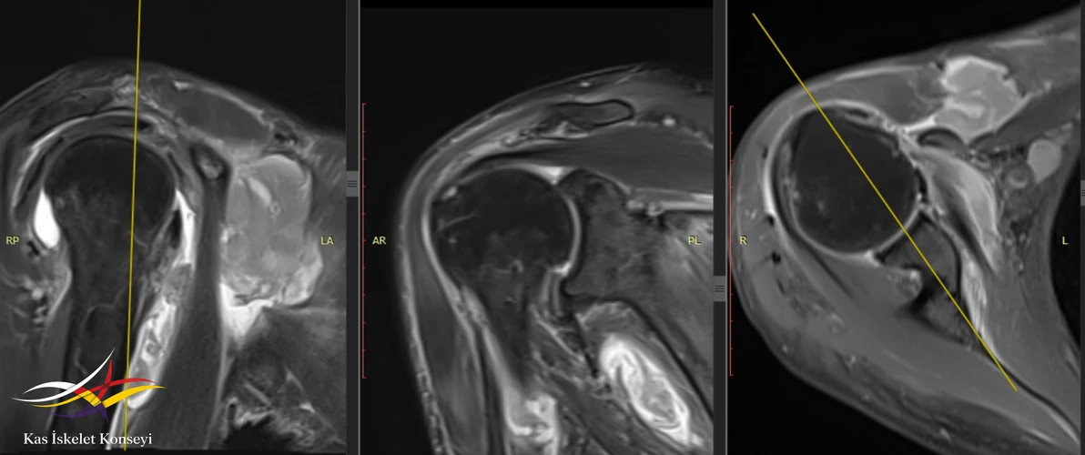 Omuz MR'ında subscapularis (rotator manşet kası) yırtığı ve biseps tendon sublüksasyonu (yarı çıkığı) saptandı.