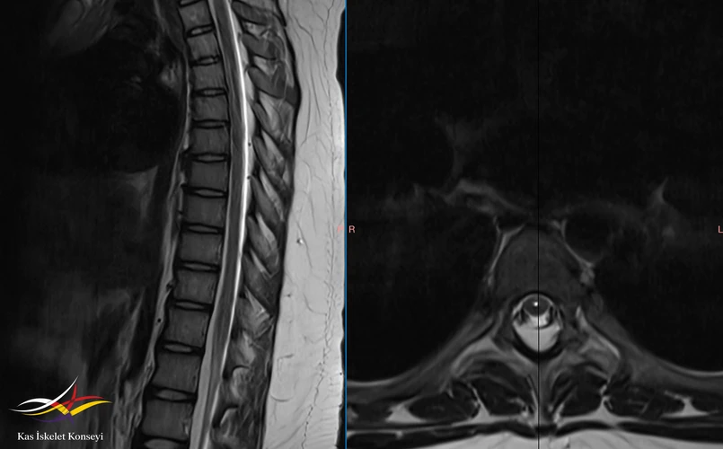 Torasik MRG de santral spinal kanalın genişlemiş olduğu ve posterior epidural alanda yağ birikimi (lipomatozis) saptandı.