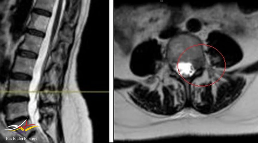 Lomber MRG'de L4-5 seviyesinde sol nöral foramende kitle imajı görülüyor.