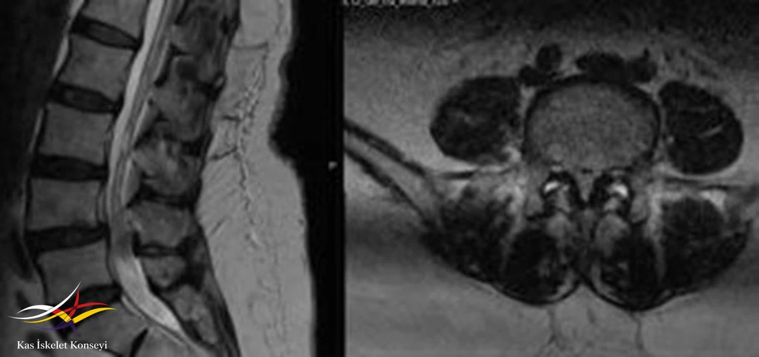 Lomber MRG'de L4-5 seviyesinde faset eklemlerde ayrışma, ligamentum flavum kalınlaşmasıyla seyreden grade 1 spondilolistezis ve buna sekonder kanal darlığı görülmekte.