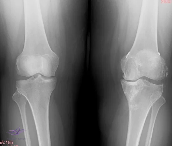 Resim 1. Direkt grafi.