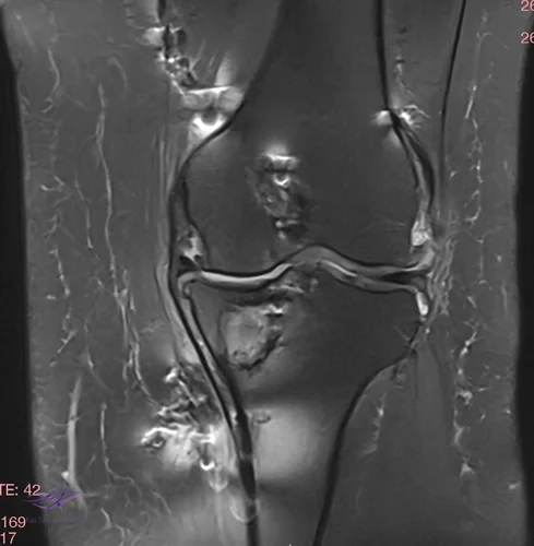 Resim 2. Koronal MRG.