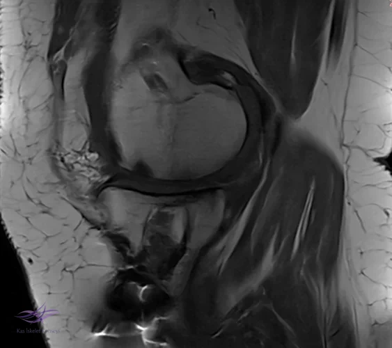 Resim 3. Sagittal MRG.