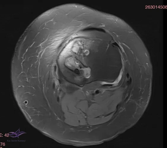 Resim 4. Aksiyal MRG.