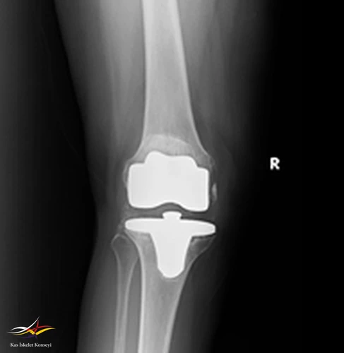 Revizyon ameliyatı öncesi AP direkt grafi.
