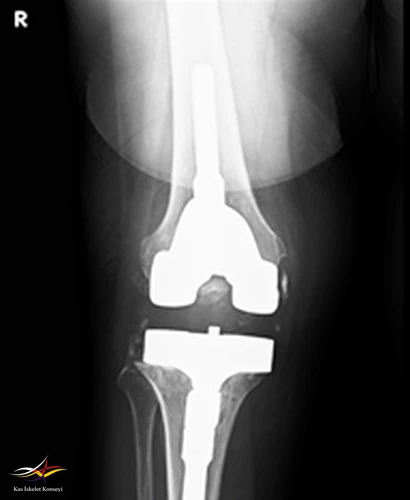 Revizyon ameliyatı sonrası AP direkt grafi.