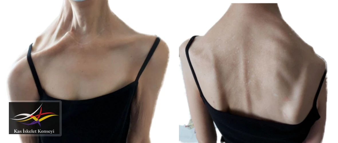 Omuz ön ve arkadan görünüm.