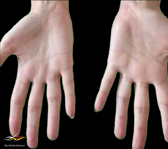Ellerin palmar görünümü.