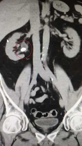 Koronal kesitli BT'de sağ börekteki taş görülmekte.