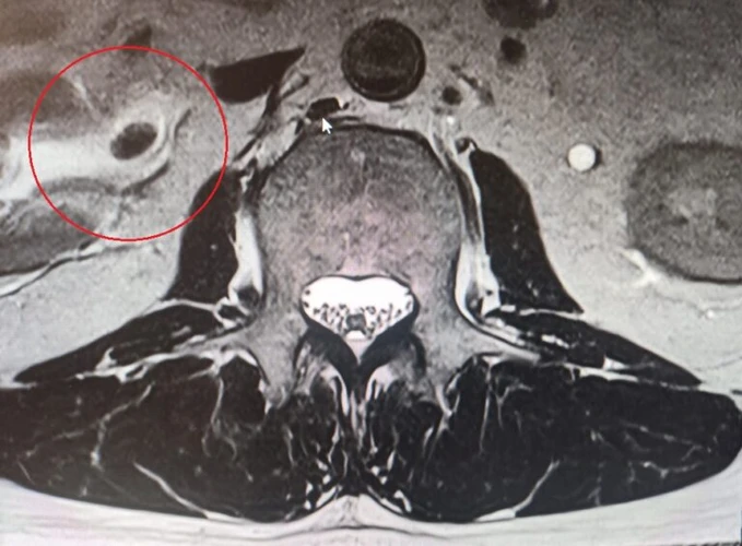 Loner MRG'de aksiyal kesitte sağ börekte hipointens lezyon görülmekte.