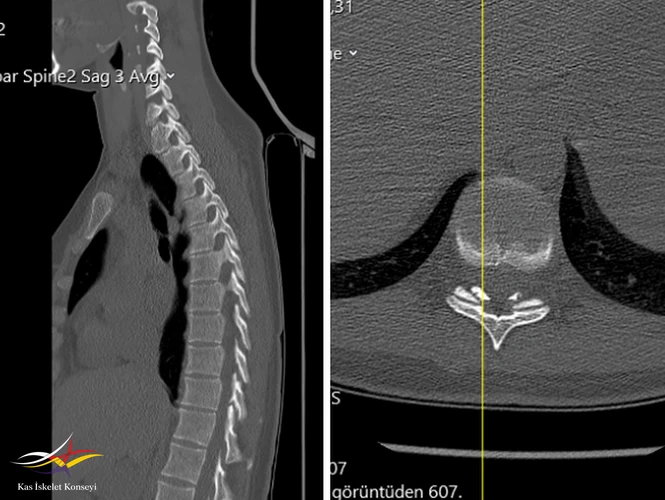 BT incelemesi aynı seviyede ligamentum flavum kalsifikasyonu gösteriyor.