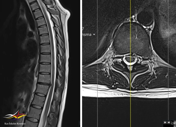 Torasik MRG alt torasik seviyede santral diskal bulgingi gösteriyor. Diskin hipointens görünümü dejenerasyonla uyumludur.