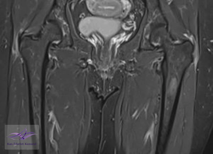 Kalça MRG koronal kesit, solda hakim iki yanlı trokanterik bursit ile uyumlu.