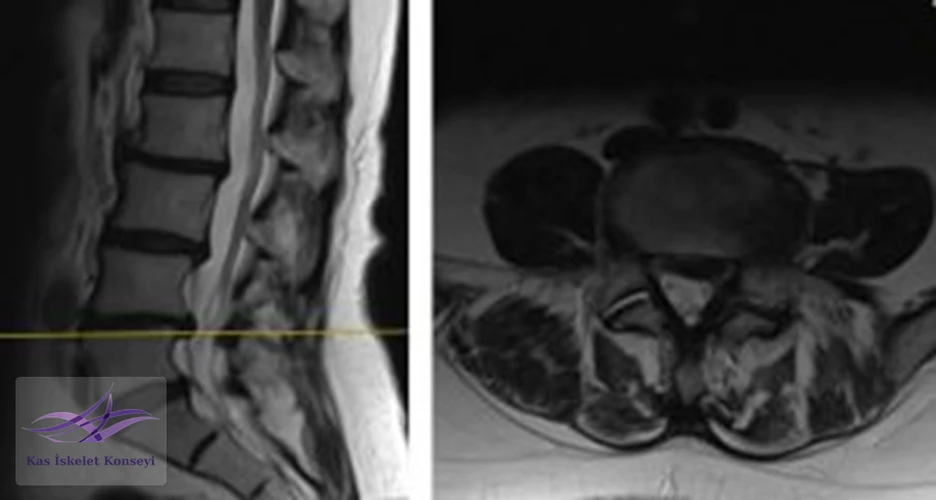 Lomber MRG, L4-5 seviyesi median kesit.