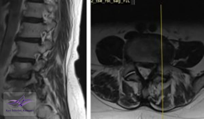 Lomber MRG, L4-5 seviyesi sol paramedian kesit foramen stenozunu göstermekte.
